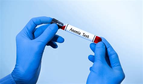 blood drop test for anemia|how is anaemia detected in a routine blood test.